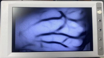 MC401 Vein Finder Easy To Use - Image 4